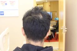 点击看大图 -大麦微针植发丨全国连锁