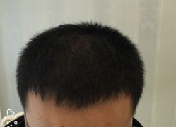 -大麦微针植发丨全国连锁