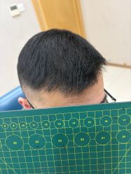 -大麦微针植发丨全国连锁