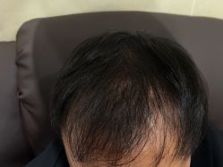 -碧莲盛·不剃发植发