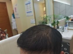 -碧莲盛·不剃发植发