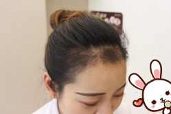 点击看大图 -大麦微针植发丨全国连锁