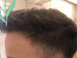 点击看大图 -大麦微针植发全国连锁