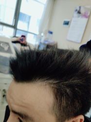 -碧莲盛·不剃发植发