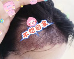 -大麦微针植发全国连锁