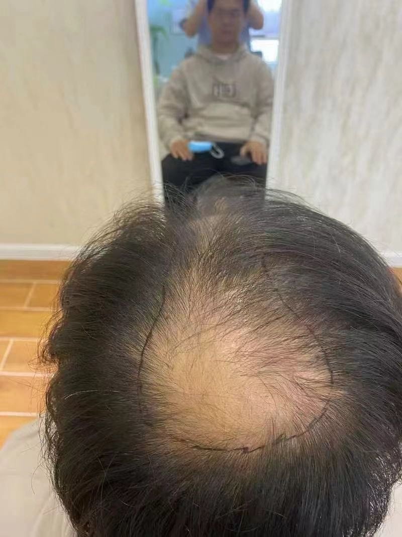 植发后头痛几年(植发后头痛几年了)