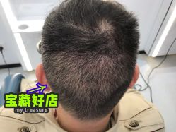 -大麦微针植发全国连锁