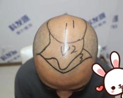 -大麦微针植发丨全国连锁