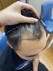 -大麦微针植发全国连锁