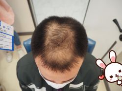 -大麦微针植发丨全国连锁