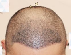 -大麦微针植发全国连锁