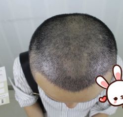 -大麦微针植发丨全国连锁