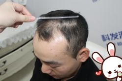 -大麦微针植发丨全国连锁