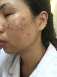 -蕾特恩专业祛痘国际连锁
