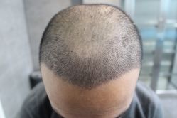 -大麦微针植发丨全国连锁