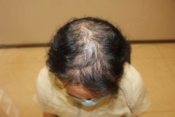 -大麦微针植发丨全国连锁