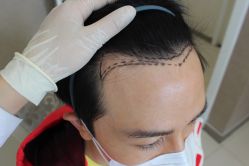 -大麦微针植发丨全国连锁