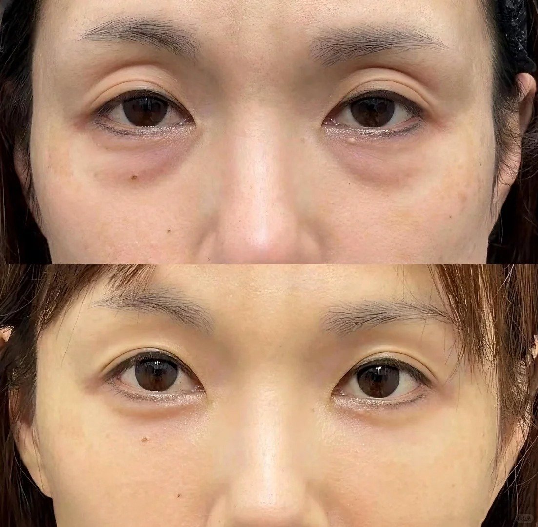 祛眼袋较好的整形美容医院（去眼袋去美容机构还是

医院好呢）