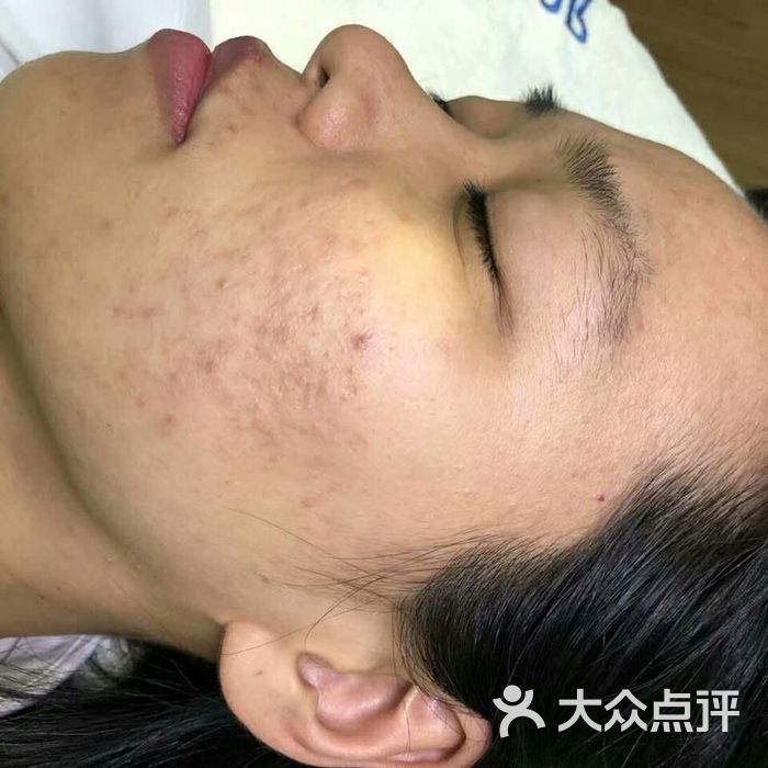 sor    索尔专业祛痘国际连锁