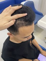 -大麦微针植发全国连锁