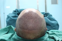 点击看大图 -大麦微针植发丨全国连锁