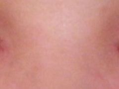 第八天-上海华安整形外科门诊部