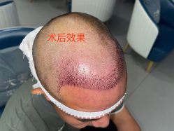点击看大图 -大麦微针植发全国连锁