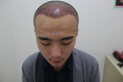 点击看大图 -大麦微针植发丨全国连锁