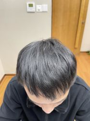 -大麦微针植发全国连锁