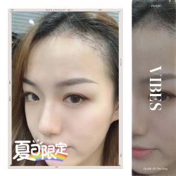 -大麦微针植发全国连锁