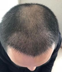 -大麦微针植发丨全国连锁