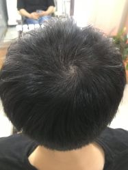 -大麦微针植发全国连锁