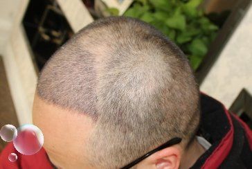 -大麦微针植发丨全国连锁