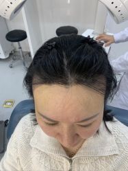 -大麦微针植发全国连锁