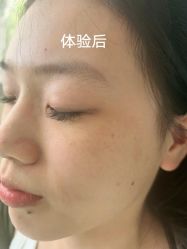 -美丽人生祛斑扁平疣汗管瘤中心