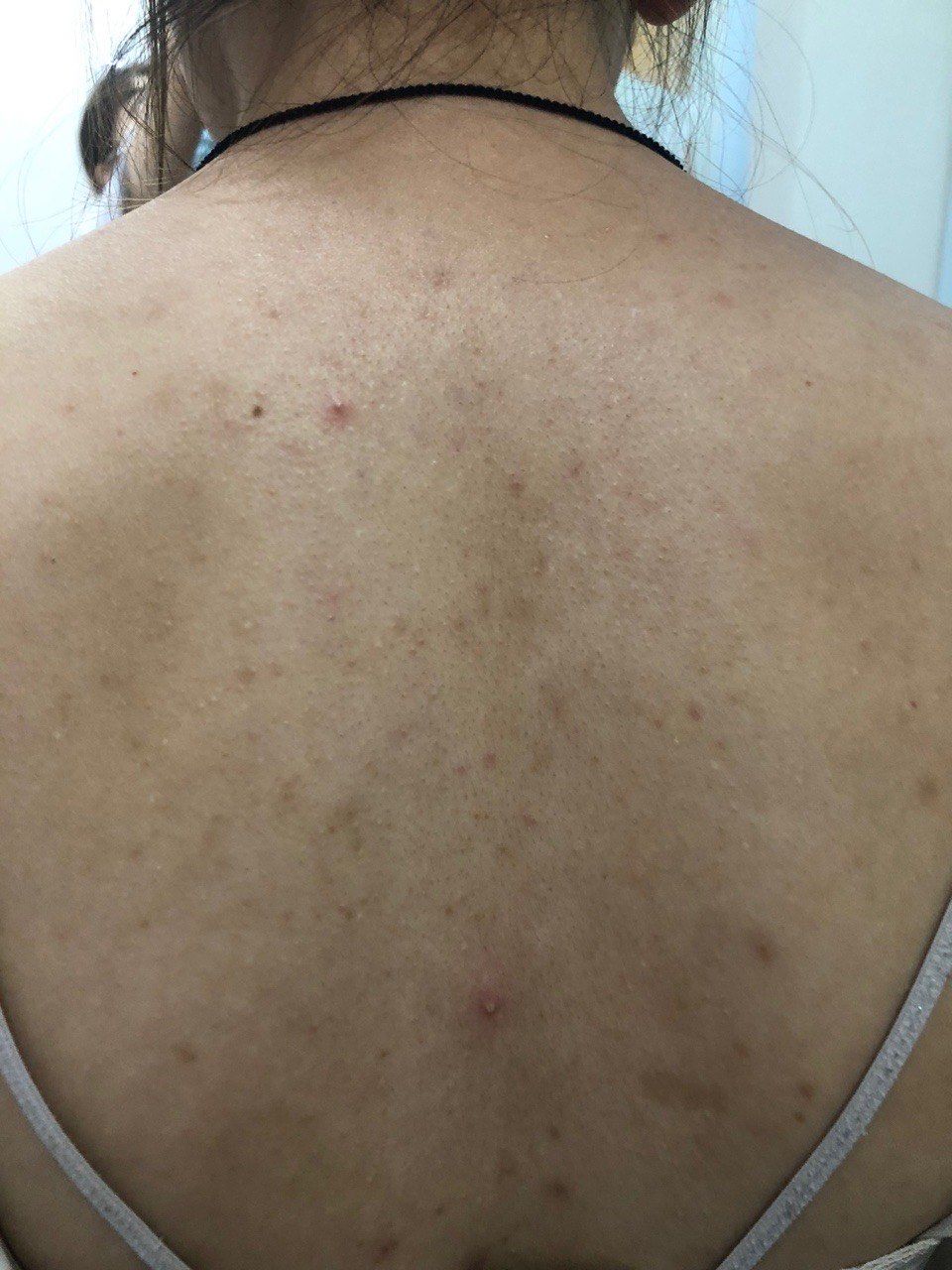 为了让背部肌肤焕发健康光泽