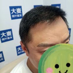 -大麦微针植发丨全国连锁