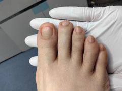 -Andrew指甲专科灰指甲·甲沟炎矫正·3D步态矫形鞋垫定制(上海法华镇路旗舰店)