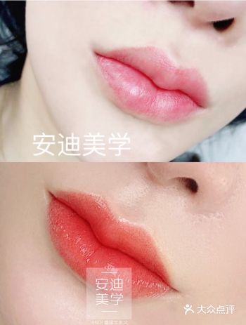 纹唇不再红肿结痂香肠嘴了，做完就很自然