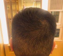 -大麦微针植发丨全国连锁