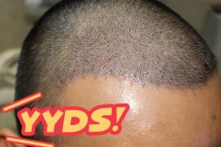 -大麦微针植发丨全国连锁