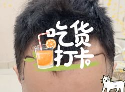 -大麦微针植发全国连锁