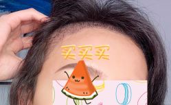 -大麦微针植发全国连锁