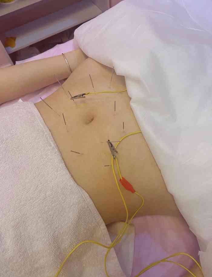 闺蜜推荐的针灸丰胸,医生找穴位挺准的.有-大众点评