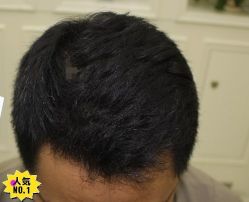 -大麦微针植发丨全国连锁