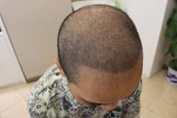 -大麦微针植发丨全国连锁