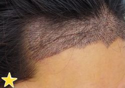 -大麦微针植发丨全国连锁