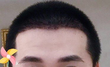 -大麦微针植发丨全国连锁