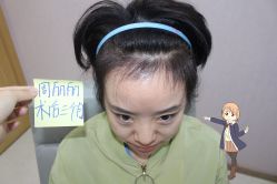 -大麦微针植发丨全国连锁