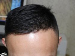 -大麦微针植发丨全国连锁